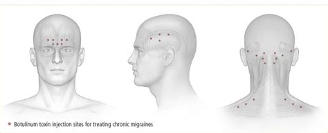 Administration of Migraine Injection .